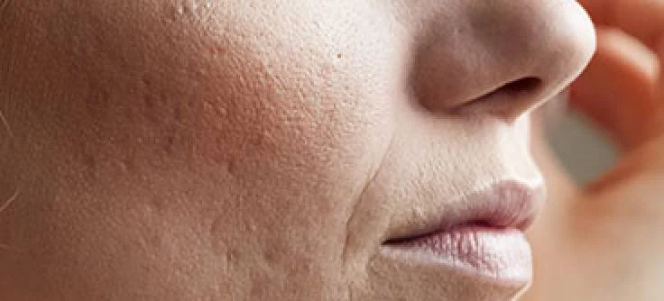 آموزش پاکسازی پوست صورت