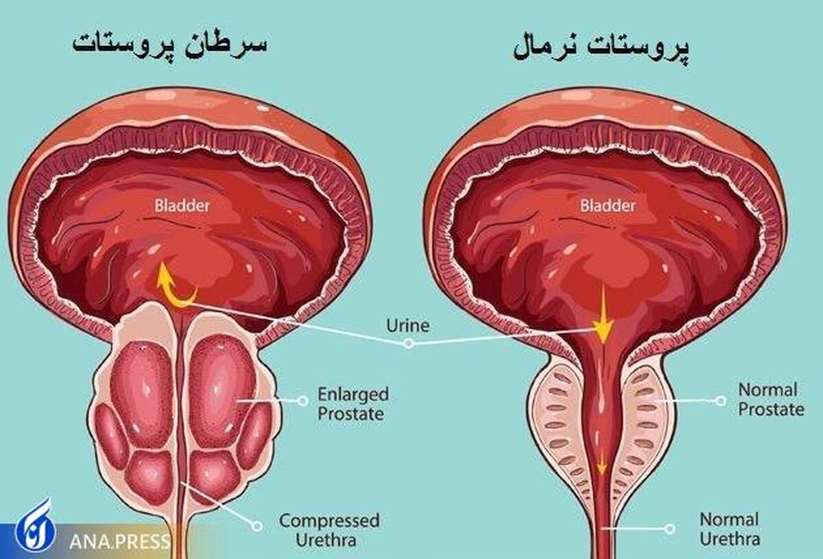 آزمایش‌های دیجیتال رکتوم برای تشخیص زودهنگام سرطان پروستات مفید نیستند