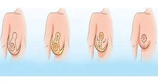 Does-breast-reduction-have-any-side-effects