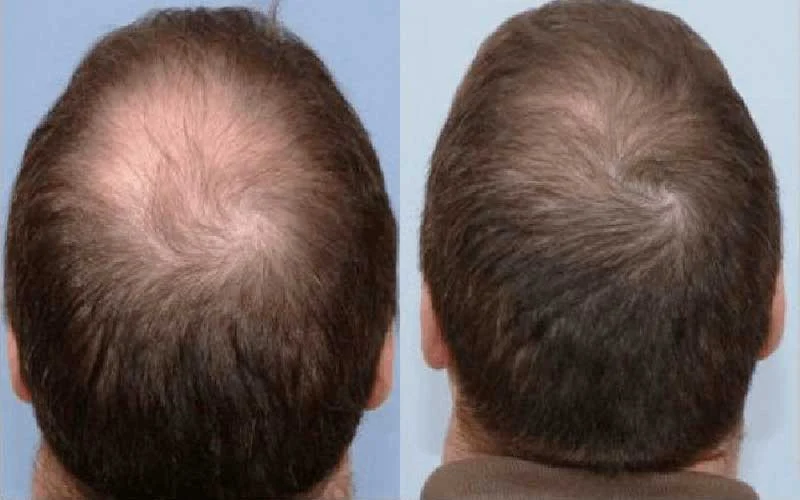 Fast hair loss treatment