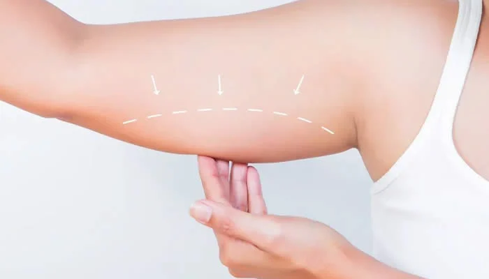Side effects of arm suction