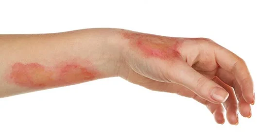 The best external burn repair cream